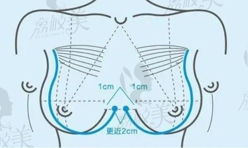 廣州美恩整形醫(yī)院隆胸醫(yī)生：許揚濱/陳宏彬/鄭志芳隆胸技術(shù)高口碑好