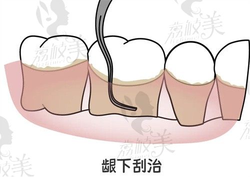 昆明竹子口腔贺光亮做龈下刮治1166起,减轻牙龈红肿控制牙周炎症很有效