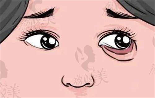 王恒醫(yī)生內(nèi)眼角修復(fù)怎么樣?技術(shù)靠譜口碑好參考案例也多修復(fù)內(nèi)眼角費用2.8W起
