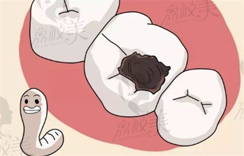 宁波恒美口腔陈希柱做前牙树脂补牙777元起,修复牙齿龋坏/龋洞效果好