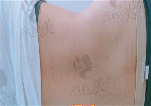 手术后