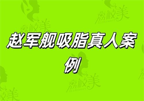赵军舰吸脂真人案例：腰腹吸脂500cc，术后7天VS3个月对比！