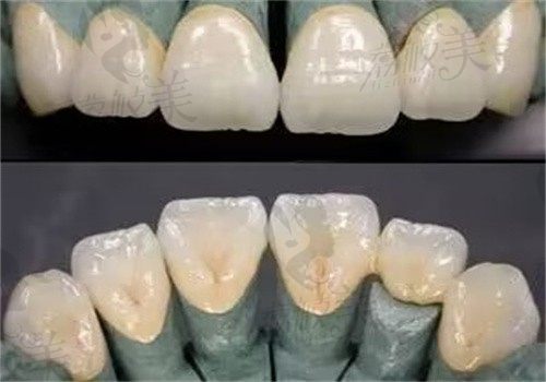 拉萨雅博仕口腔王克勤做义获嘉树脂填充补牙价格200起，填充结果和真牙一样
