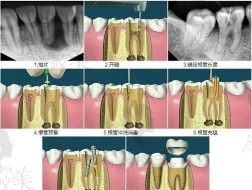 杭州英博口腔潘超杰做后磨牙根管治療價格1180起,延長牙齒壽命