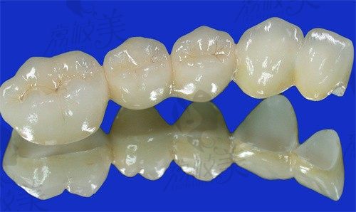 邹平优贝口腔王怀滨做德国威兰德牙冠1369起,品质好性价比高