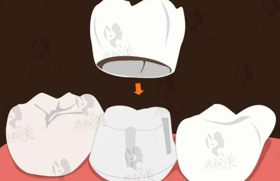 纯钛牙冠500元贵吗是坑还是赚？全国市场价对比+成本拆解，避坑必看指南