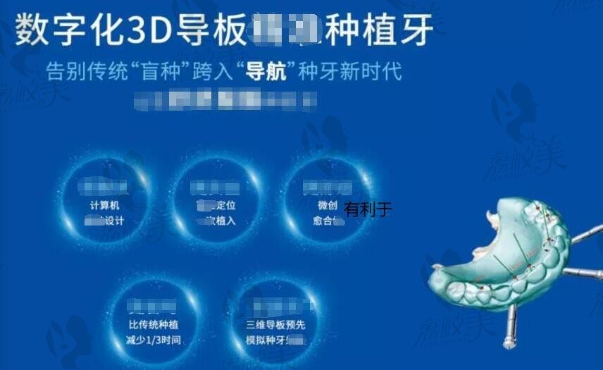 全口即刻种植比常规贵多少钱？10大品牌费用差+优缺点揭秘，这样选最省钱