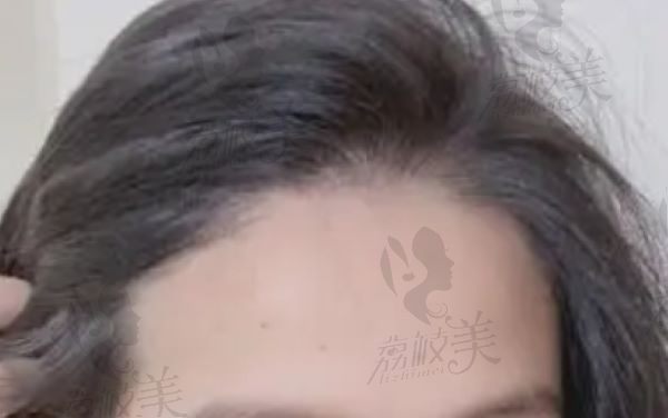 北京八大处植发费用一览表：9000元至8万元不等收费透明技术好