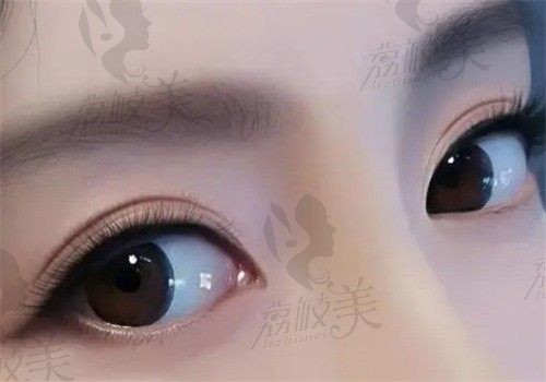 闫品行做双眼皮技术真的不错，操作精细手还稳让我的肿眼泡变成灵动双眼皮