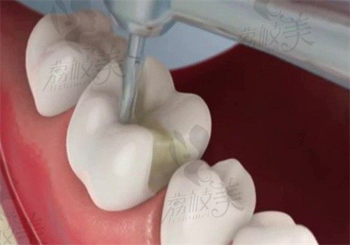 临海爱齿口腔医院黄赓做美国进口P60树脂补牙费用500元起，坚固耐用