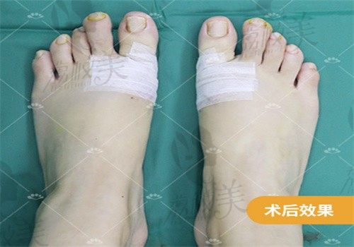 手术后