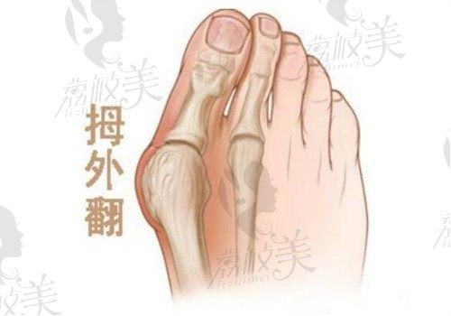 马桂文大脚骨手术深度测评：2025最新价格+真人案例！30分钟矫正真的假的？