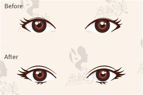 贺曼做双眼皮属于什么档次?属高端档次,专利"动态褶皱术"技术好案例多