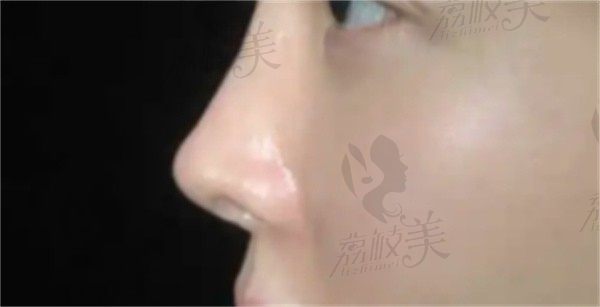 手术后