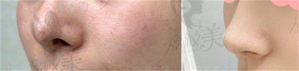 鼻修复逆袭实录！赤峰红山伊莲美人医疗美容李京霖重塑我的自信美鼻