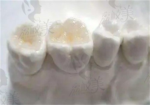 如皋固德口腔医院邹凯贤做高端纳米树脂补牙268元起，适用于虫牙\蛀牙等