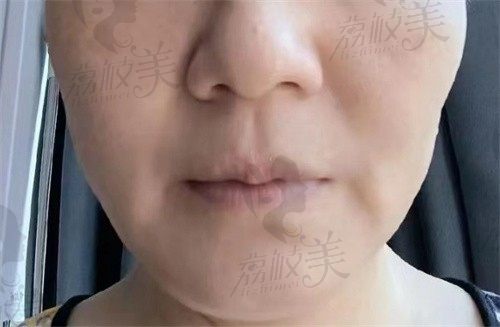 手术前