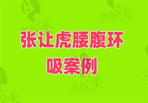 张让虎腰腹环吸案例全记录：1次手术马甲线立现，体重没掉但瘦了！