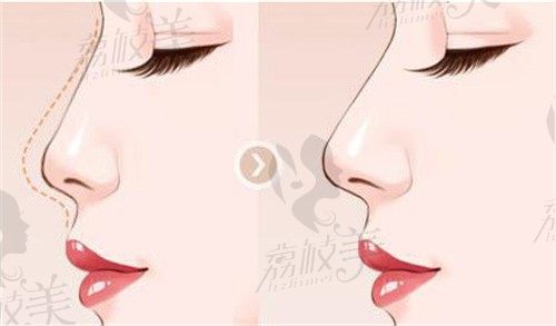 杭州項昌峰做鼻子怎么樣?技術(shù)風格+收費價格+真實案例測評(附2025預(yù)約指南)