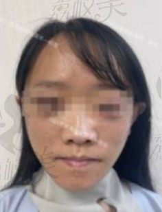 手术后
