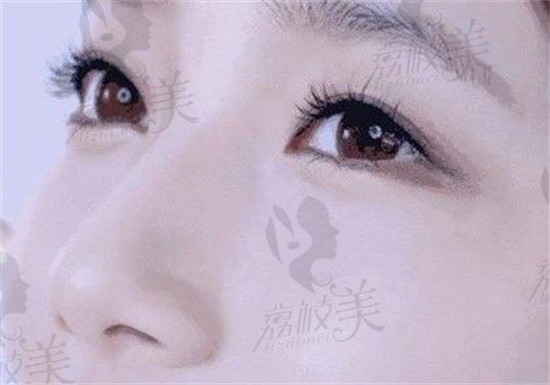 为什么选择周瑜医生修复双眼皮？素人术后四个月全细节曝光