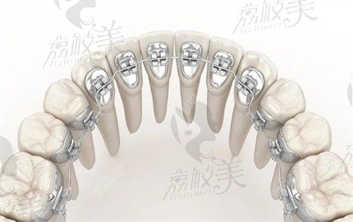 正畸徐寶華和張棟梁誰(shuí)厲害?北京正畸專家PK:隱形矯正/舌側(cè)矯正誰(shuí)更值得選?