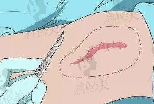 武晓莉的号怎么预约？亲测3种挂号捷径！同水平疤痕修复医生平替推荐