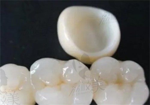 湖州复大中齿口腔医院刘耿彪医生做爱尔创全瓷牙980元起，修复牙齿缺损