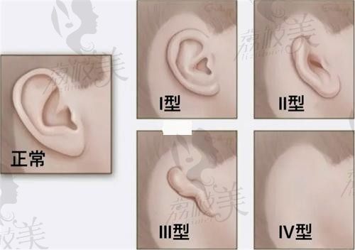 上海海华安洪宾做耳再造手术7万起,3D生物材料支架+骨桥装置更真实