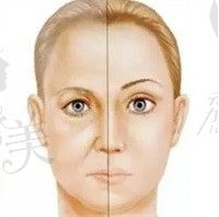 成都新麗美游曉波面部年輕化拉皮3.8~6.8W不等,精細(xì)操作不傷面部神經(jīng)