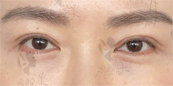于武汉健丽寻陈文博修复失败双眼，一月蜕变收获自信新颜