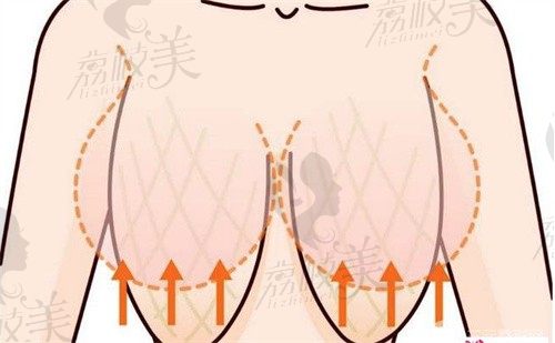 花苞提升手術(shù)和雙環(huán)懸吊提升手術(shù)的區(qū)別:深度解析技術(shù)差異/維持時(shí)間/適合年齡等