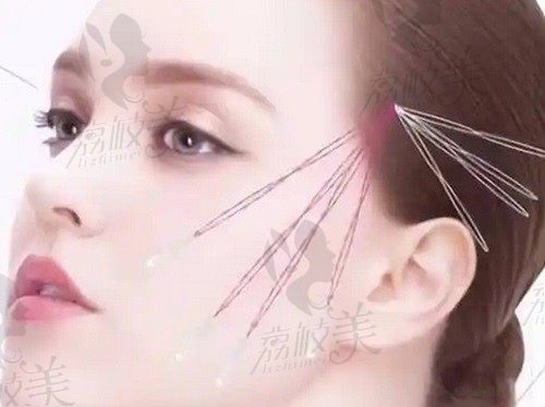 成都劉遠程筋膜提升的價位在10000-50000元，性價比很高值得入手