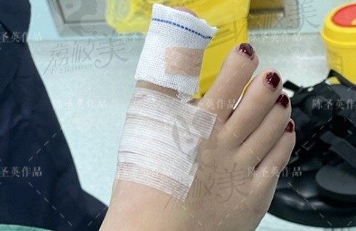 拇外翻蘇敬達(dá)醫(yī)生值得推薦：蘇敬達(dá)做大腳骨手術(shù)技術(shù)水平賊高費(fèi)用也不貴