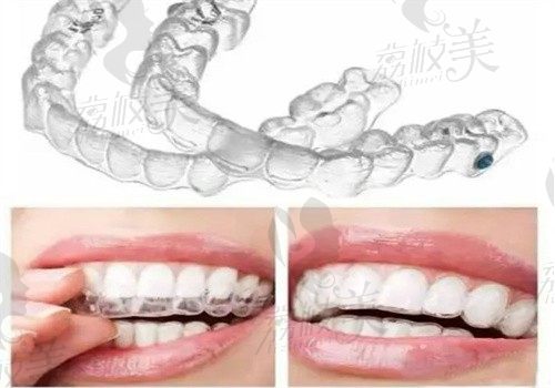 湖州英博口腔医院姜萍做隐适美矫正29779元起，隐形矫正更美观舒适