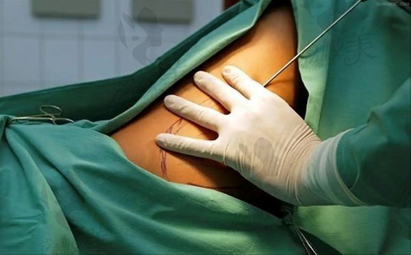 北京知音的抽脂怎样？看了技术优势+价格+患者真实评价特别靠谱
