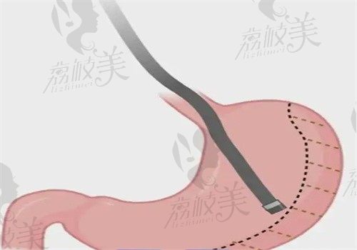 四川現(xiàn)代醫(yī)院劉亞平做胃轉(zhuǎn)流支架手術(shù)價格5萬~7萬起，不含取支架費用