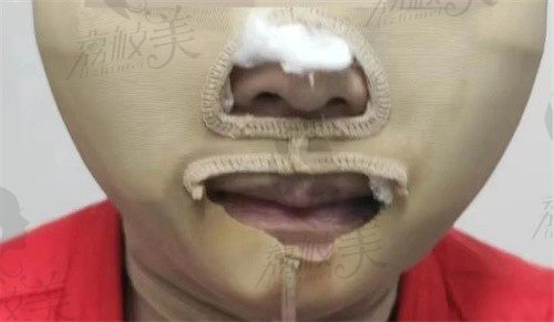 56岁去北京找毕洪森做内窥镜面部拉皮,朋友都说我像换了个头!术后180天跟踪记录…