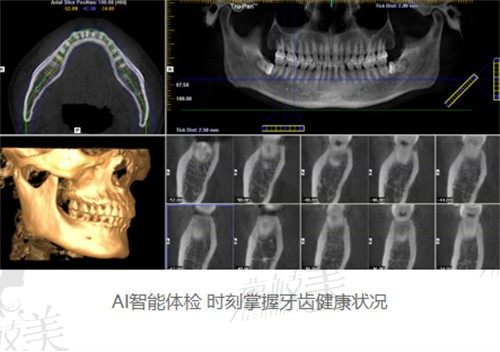 亳州德諾口腔何志強做韓國進口種植牙2580起,壽命長性價比高