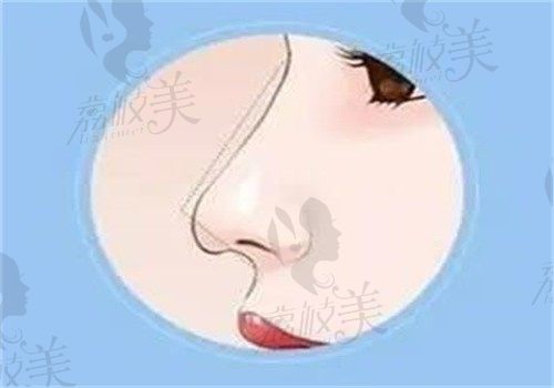 成都大象致顏周柯做攣縮鼻修復(fù)價(jià)格7萬起，術(shù)后鼻形自然評(píng)價(jià)高