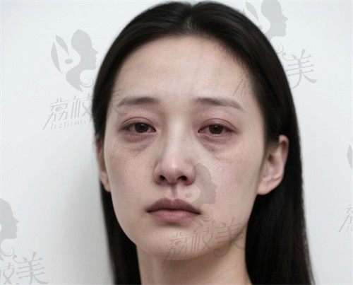 手术前