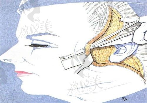 深圳今喜曹孟君做彈力線提升價(jià)格是10萬起，可有效改善面部下垂現(xiàn)象