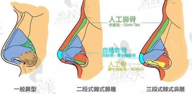 成都周柯鼻修復(fù)費(fèi)用25000~150000+，這位主攻鼻整形的院長技術(shù)從未讓人失望