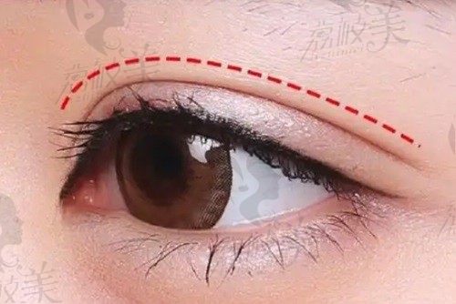 上海佀同帅医生双眼皮修复怎么样？佀同帅修复眼睛超好有范例为证
