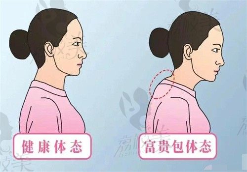 富贵包消除术亲测：广州李方伟医生技术如何？术前术后对比图公开
