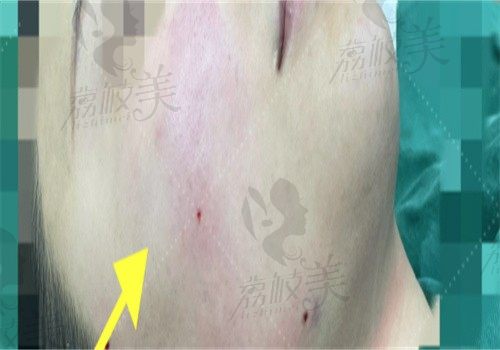手术后