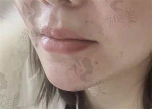 手术后