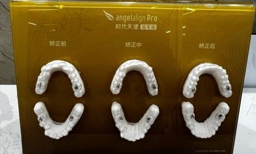 兰州一柚口腔种植牙价格2656起，牙齿矫正7480起，附医院项目价格明细