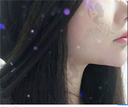 手术后
