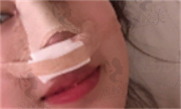 手术后